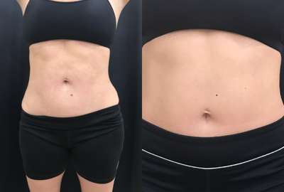 25-34 year old woman treated with Velashape - This patient had liposuction. She was pleased with the uneven appearance of her skin . This comparison was taken after 2 Treatments with Velashape 3