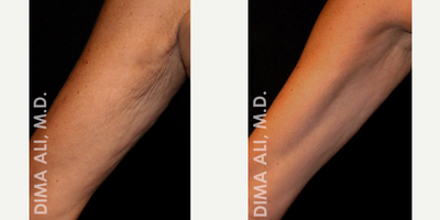 55-64 year old woman treated with Venus Freeze - At WellMedica we provide Venus Freeze treatments for the arms. Venus Freeze is suitable for various face and body applications including circumference reduction, cellulite improvement, skin tightening and wrinkle reduction. Treatments are safe, quick and effective for all skin types.