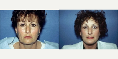 45-54 year old woman treated with Facelift - After her facelift at our Sacramento practice with Dr. Yamahata, this woman looks like a younger version of herself. Her facial features have been enhanced by the reduction of lines, wrinkles, and sagging skin, especially along her jawline and neck.
