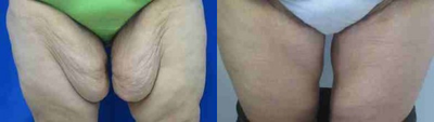 Thigh Lift - Thigh Lift