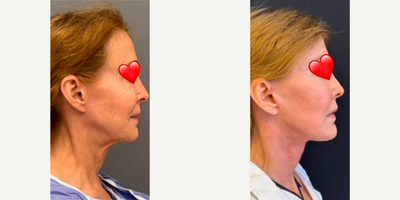 Woman treated with Facelift Revision  - Woman treated with Facelift Revision through Deep Plane Facelift as well as Neck Lift, Temporal Brow Lift, Facial Fat Transfer, and Lip Lift.