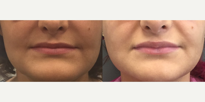 21 year old woman treated with Lip Implants - 21 year old female was unhappy with the size of her lips. She underwent augmentation with medium size (4mm) permanent lips implants to the upper and lower lips.