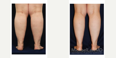 55-64 year old woman treated with Calf Reduction - Lower Leg Liposuction