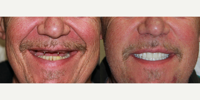 All-on-4 Dental Implants - All-on-4 Dental Implants