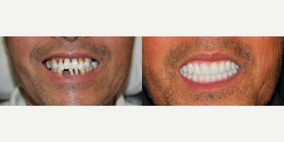 All-on-4 Dental Implants - All-on-4 Dental Implants