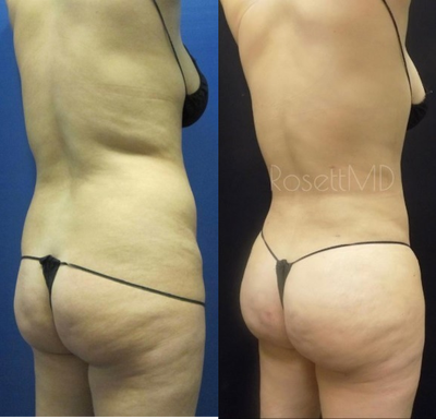 Woman treated with Brazilian Butt Lift - Everyone always wants to know what the long-term results are going to be for a fat transfer so this patient is 1 year post op after a BBL and has enough confidence for everyone who sees this.