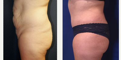 25-34 year old woman treated with Tummy Tuck - 32 year old female
Abdominoplasty
