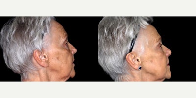 72 year old woman treated with 3 syringes of Bellafill to cheeks and under eye - 72 year old woman treated with 3 syringes of Bellafill to cheeks and under eye. Photos depict before and 3 months after treatment.