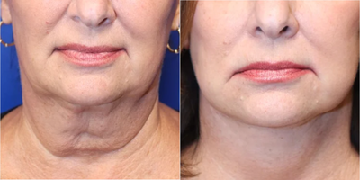 55-64 year old woman treated with Facelift, Neck Lift, Skin Rejuvenation, Skin Tightening - 55-64 year old woman treated with Facelift, Neck Lift, Skin Rejuvenation, Skin Tightening