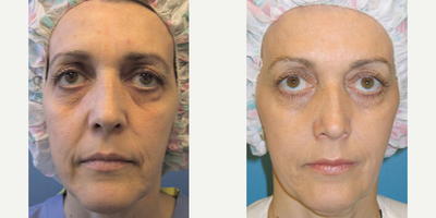 Woman treated with Thermage - Woman treated with Thermage to face