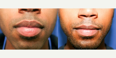 25-34 year old man treated with Lip Reduction - A 26-year-old cosmetic surgery patient came to our plastic surgery clinic requesting improvement of his chin and lips. He wanted more square, masculine chin and mild reduction of his lips.

Clinical evaluation revealed a small, narrow chin positioned far behind his protruding lips and nose on profile view. He also demonstrated narrow chin which was over-shadowed by large lips on front view (left). It included placement of a large chin implant  through a small incision placed inside of the mouth as well as reduction of upper and lower lips.

Preoperative images on the (left); after lip surgery and chin enlargement with silicone implant on the right. Notice increase in chin projection and size on profile view and strong, masculine, square chin and proportionally smaller lips. This gives much more balance and harmony to his entire face
