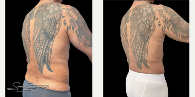 55-64 year old man treated with Abdominal Etching, Liposuction, Lymphatic Massage, Renuvion, Scar Removal, Skin Tightening, Vase - 55 year old gentleman who underwent VASER assisted liposculpting and Renuvion J plasma skin tightening of the abdomen, flanks, chest, axilla, lower back; chest masculinization procedure with fat grafting to the chest.