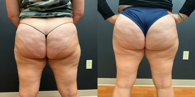 45-54 year old woman treated with Qwo - After 2 treatments of QWO for cellulite