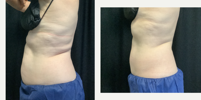Woman treated with CoolSculpting Elite - Pre-Treatment vs Post-Treatment CoolSCulpting Elite. This patient had 2 rounds of CoolSculpting, 4 weeks apart.