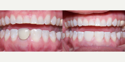 55-64 year old woman treated with Dental Crown - Dental Crowns on 55-64 year old female.