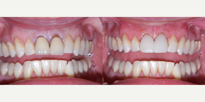 55-64 year old man treated with Dental Crown - Dental Crowns on 55-64 year old male.