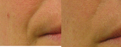 35-44 year old woman treated with HydraFacial for wrinkle reduction - HydraFacialMD may be useful for acne, wrinkles, brown discoloration, and restoring a youthful facial appearance. These photos are following five treatments at monthly intervals.&nbsp;