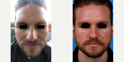 Man in his late 20s treated with Facial Reconstructive Surgery - Man in his late 20s treated with Rhinoplasty and Facial Reconstructive Surgery. Patient sustained an acute nasal bone fracture while in martial arts training, resulting in significant nasal deviation. The nasal bones were carefully reduced to restore his original pre-injury appearance.