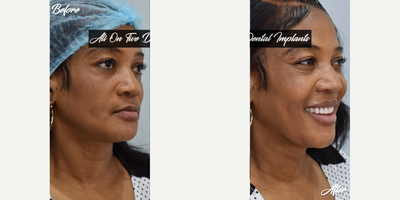 45-54 year old woman treated with All-on-4 Dental Implants, Dental Implants, Dental Bone Graft, Smile Makeover, Botox - This patient wanted to have her teeth fixed.