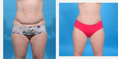 45-54 year old woman treated with Abdominal Etching and tummy tuck revision - This patient was unhappy with the results of her tummy tuck by another surgeon. For her revision I lowered her scar so that it could be hidden in underwear. I removed more skin and fat, I re-tightened her abdominal muscles using a 3 vector corset plication technique to cinch in her waist. I then used VASER ultrasound liposuction. to etch out her abdominal muscles and carve our her waist to give her an hourglass shape.