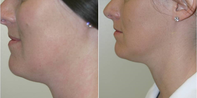 35-44 year old woman treated with TITAN - Skin Tightening with TITAN for neck laxity