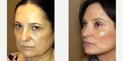 Woman treated with Facelift - Woman treated with mid facelift, endoscopic brow lift, buccal fat pad removal and necklift.