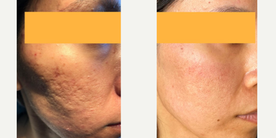 Woman treated with Venus Viva, MiXto Laser - Details - Acne treated with lasers and fillers