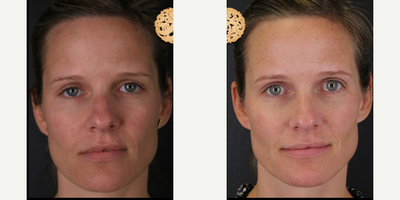 35-44 year old woman treated with Dermalinfusion - Dermal Infusion - Before & After