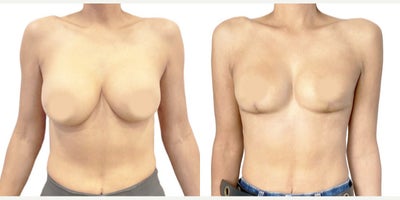 35-44 year old woman treated with Breast Implant Removal, Breast Reconstruction, Breast Lift - Breast implant removal is more than just removing the prosthesis and capsules. It's reconstructive surgery that has aesthetic goals for our patients. The great thing about this surgery is that we can use the patient's tissue for reconstruction, allowing immediate results. Plus, it's almost always painless and leaves an L-shaped scar with no scars in the cleavage area. Thanks to the BRALAN Technique(Breast Reconstruction Anatomical Lift Augmentation), we can achieve a consistent and stable aesthetic result regardless of breast tissue size.