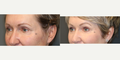 Stem Cell Rich Fat Transfer and Laser - Fat transfer to upper eyelids and face with laser treatment and scar treatment.