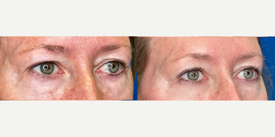 35-44 year old woman treated with Endolift, Brow Lift, Skin Rejuvenation, Skin Tightening - Endolift Laser tightens lax tissue, contours and stimulates your collagen. Using the Endolift Laser the lower right brow was lifted. Note less upper lid skin on the right after the Endolift Laser. This is a non-surgical browlift.