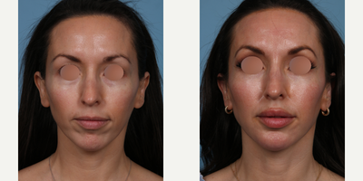 35-44 year old woman treated with Sculptra, Chin Implant, Botox - Our patient was so happy with her natural chin implant & Sculptra injection results that she agreed to share her beautiful results with you. Two years ago, at age 38, she felt that she was starting to look tired due to under eye circles and loss of youthful volume along her temples, cheeks, jaw line and chin. She was interested in longer lasting results. She continues to maintain her Botox treatments to prevent the formation of fine lines and wrinkles and boost her Sculptra results, which can last more than 2 years.