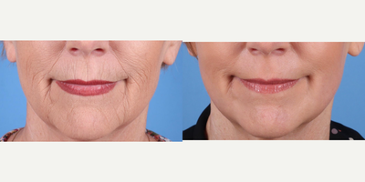 64 year old woman treated with Phenol Peel to full face - Dr.Sukkar performed a Phenol Peel to this 64 year old patient. Photos taken at 3 months post op.(281) 990-8487 | 14018 Aesthetic Circle Houston, TX 77062 | www.drsukkar.com