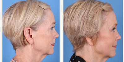 64 year old woman treated with Phenol Peel to full face - Dr.Sukkar performed a Phenol Peel to this 64 year old patient. Photos taken at 3 months post op.(281) 990-8487 | 14018 Aesthetic Circle Houston, TX 77062 | www.drsukkar.com