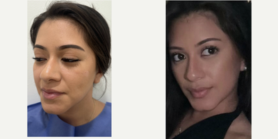 25-34 year old woman treated with Buccal Fat Removal - 33 y.o female who underwent buccal fat reduction