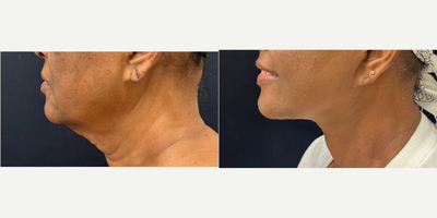 45-54 year old woman treated with Facelift, Deep Plane Facelift - 53 y.o female who underwent deep plane facelift, neckift. She was awake yet comfortable for the procedure