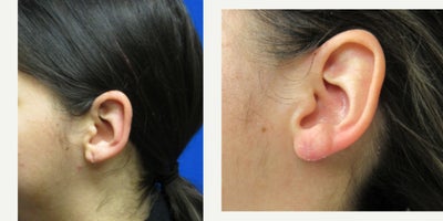 Earlobe Repair - Earlobe repair by Dr. Eric Schaffer to fix an elongated earring hole using local anesthesia. Re-piercing done 3 months after the procedure.