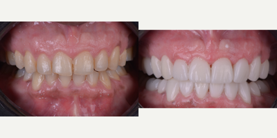 25-34 year old man treated with Lumineers - 20 Porcelain Veneers color Bleach 2, texture and digital design.