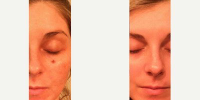 Woman treated with VI Peel - Woman treated with VI Peel.