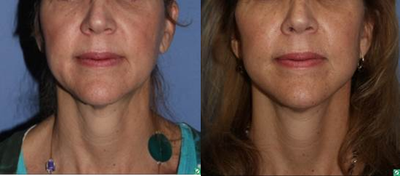 face and neck lift, 54 year old - This 54 year old comes to see us because she is unhappy with her jowls and the overall look of her lower face.
