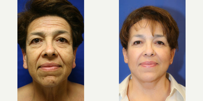 Eyelid Surgery - This is 61 year old female. She was not happy with the appearance of her face or neck. She underwent a face lift, neck lift, brow lift, upper and lower blepharoplasty and earlobe reduction. - Individual Results May Vary