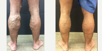Huge bulging varicose veins treated with Varithena - These are some of our favorite before and after pictures yet! The treatment plan included a RF ablation, Varithena, phlebectomy, and sclerotherapy injections.