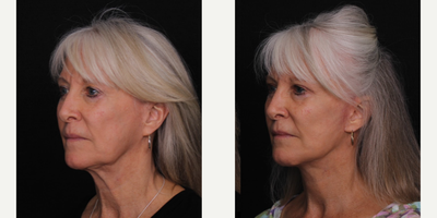 65-74 year old woman treated with Facelift - Female patient 1 month after facelift.