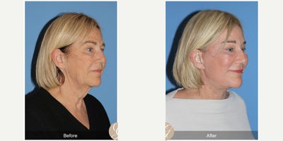 68 year old woman treated with Deep Plane Facelift, Neck Lift, Brow Lift, CO2 Laser, MACS Facelift - 68 year old woman treated with Deep Plane Face and Neck Lift, Temporal Brow Lift, CO2 Laser of Face, MAC