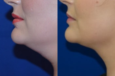 Woman treated with Injectable Fillers - Woman treated with Injectable Fillers. This patient came in wanting to know what non-surgical options she had for fat reduction underneath the chin. After visiting with Dr. Ho, the patient elected to have a Kybella treatment.