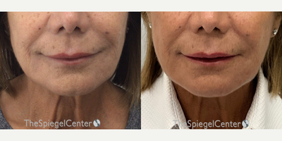 65-74 year old woman treated with Ellacor - Ellacor