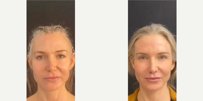 Woman treated with Eyelid Surgery - Woman treated with Eyelid Surgery as well asLip Lift,Brow Lift, and Facial Fat Transfer.
