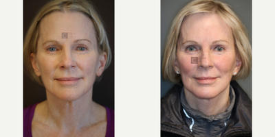Quick Lift - Lift with laser treatment.