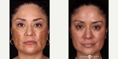 Woman treated with Clear and Brilliant - Woman treated with Clear and Brilliant