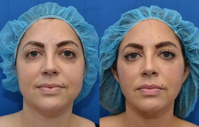 Woman treated with Renuvion - Precision Sculpt of the chin and neck aided with Renuvion and buccal fat removal / lipectomy cheek reduction